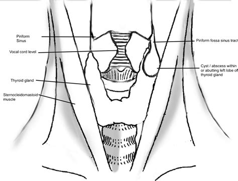 Pyriform sinus 